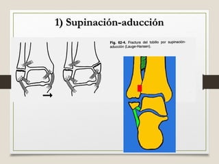Fracturas de tobillo Clasificaci n De Lauge Hansen ppt fracturas-de-tobillo-clasificaci-n-de-lauge-hansen-ppt
