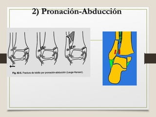 Fracturas de tobillo Clasificaci n De Lauge Hansen ppt fracturas-de-tobillo-clasificaci-n-de-lauge-hansen-ppt