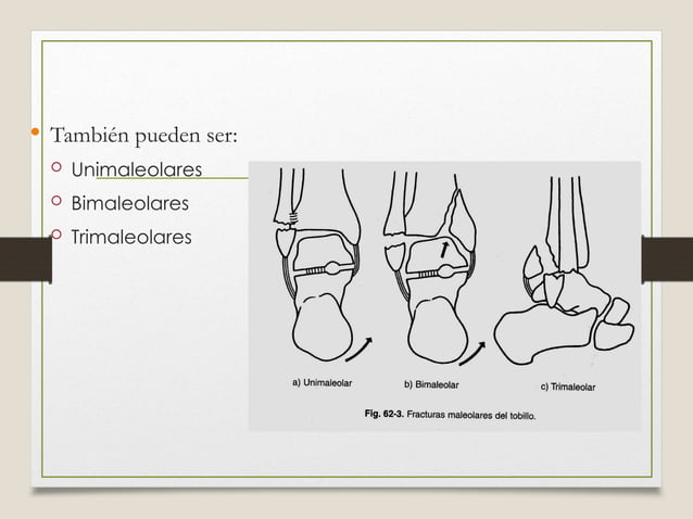 Fracturas de tobillo Clasificaci n De Lauge Hansen ppt fracturas-de-tobillo-clasificaci-n-de-lauge-hansen-ppt