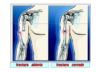 fractura abierta   fractura cerrada
 