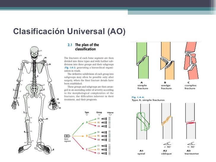 Fracturas