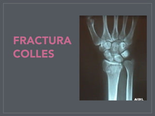 FRACTURA
COLLES