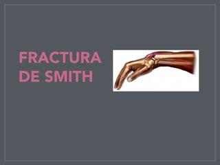 FRACTURA
DE SMITH