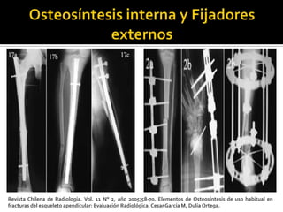 Revista Chilena de Radiología. Vol. 11 N° 2, año 2005;58-70. Elementos de Osteosíntesis de uso habitual en
fracturas del esqueleto apendicular: Evaluación Radiológica. Cesar García M, Dulía Ortega.
 