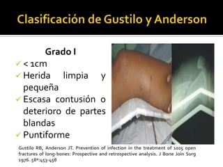 Grado I
 < 1cm
 Herida   limpia y
  pequeña
 Escasa contusión o
  deterioro de partes
  blandas
 Puntiforme
Gustilo RB, Anderson JT. Prevention of infection in the treatment of 1025 open
fractures of long-bones: Prospective and retrospective analysis. J Bone Join Surg
1976. 58ª:453-458
 