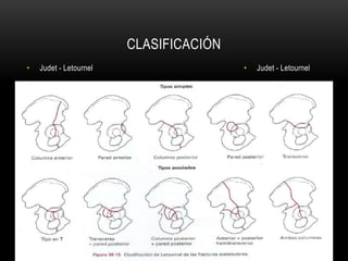 Judet Letournel Classification Fracturas acetabulares | PPTX