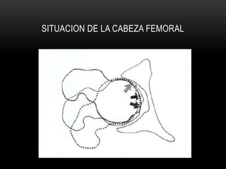SITUACION DE LA CABEZA FEMORAL
 