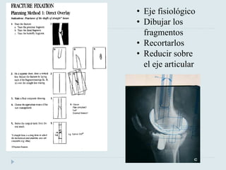 • Eje fisiológico 
• Dibujar los 
fragmentos 
• Recortarlos 
• Reducir sobre 
el eje articular 
 