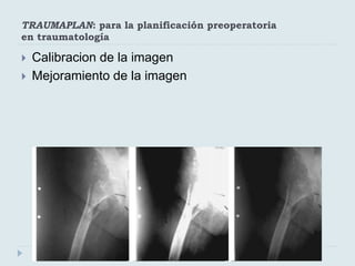 TRAUMAPLAN: para la planificación preoperatoria 
en traumatología 
 Calibracion de la imagen 
 Mejoramiento de la imagen 
 
