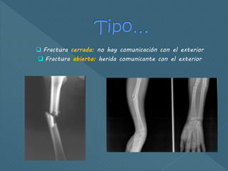  Fractura cerrada: no hay comunicación con el exterior
 Fractura abierta: herida comunicante con el exterior
 