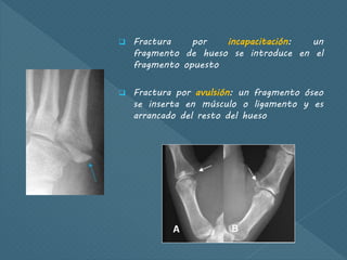  Fractura por incapacitación: un
fragmento de hueso se introduce en el
fragmento opuesto
 Fractura por avulsión: un fragmento óseo
se inserta en músculo o ligamento y es
arrancado del resto del hueso
 