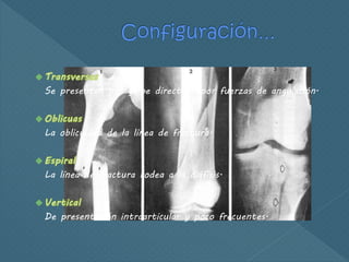 Se presentan por golpe directo o por fuerzas de angulación.
La oblicuidad de la línea de fractura.
La línea de fractura rodea a la diáfisis.
De presentación intraarticular y poco frecuentes.
 