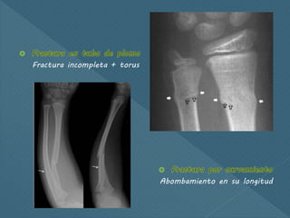 Fractura incompleta + torus
Abombamiento en su longitud
 