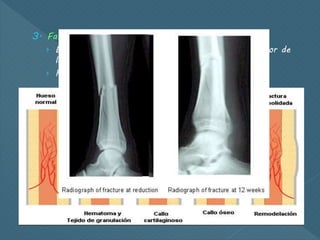 3. Fase de remodelación
› El hueso nuevo forma un collar redondeado alrededor de
la fractura
› Remodelación ósea  callo maduro
 
