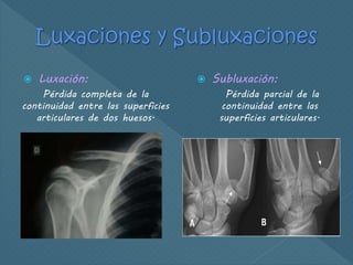  Luxación:
Pérdida completa de la
continuidad entre las superficies
articulares de dos huesos.
 Subluxación:
Pérdida parcial de la
continuidad entre las
superficies articulares.
 