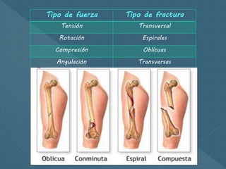 Tipo de fuerza Tipo de fractura
Tensión Transversal
Rotación Espirales
Compresión Oblícuas
Angulación Transversas
Angulación + Compresión Ala de mariposa
Angulación + Rotación Oblicua de 45°
 