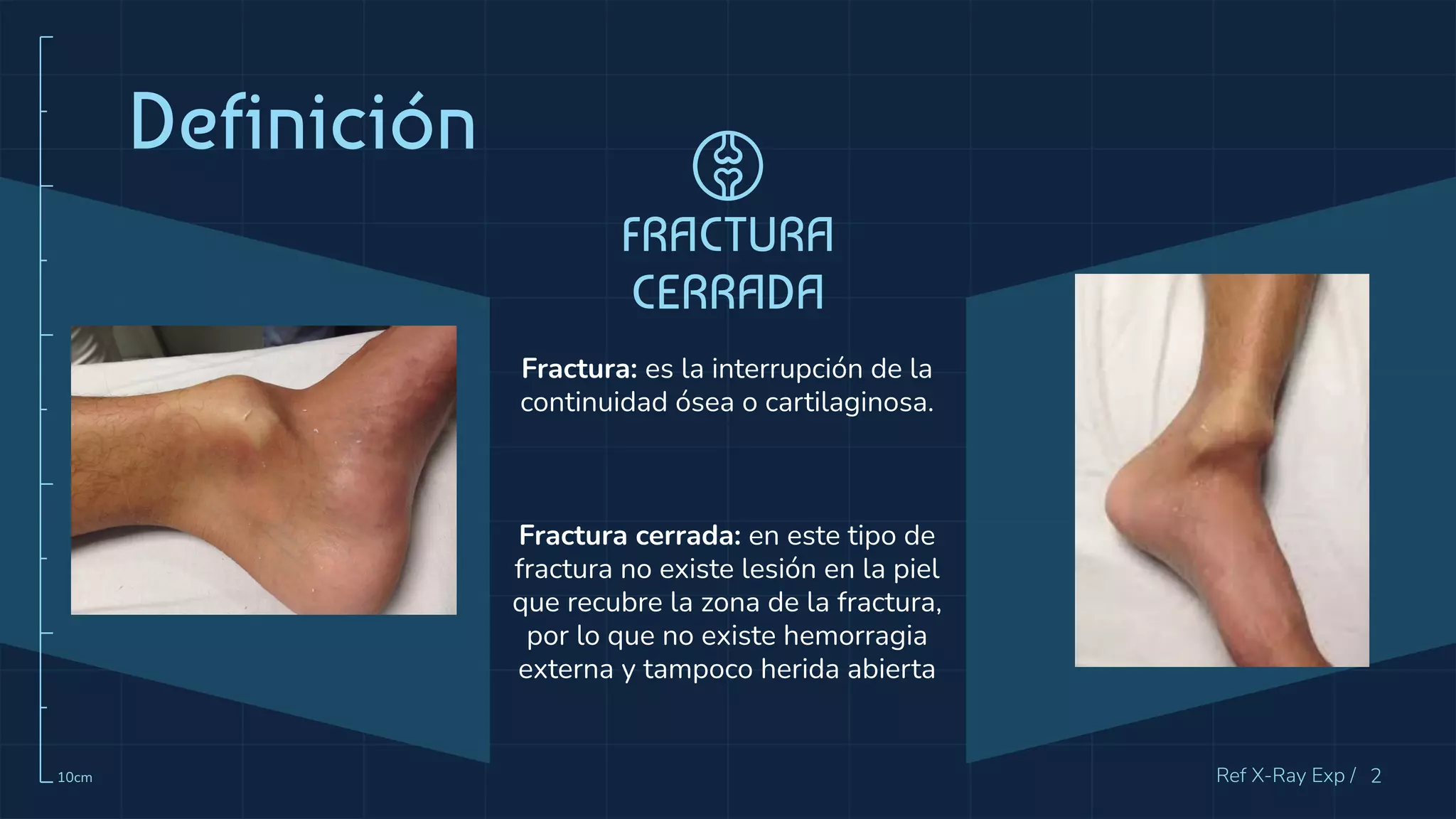 Fracturas Cerradas - Ortopedia.pdf