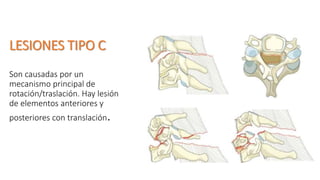 LESIONES TIPO C
Son causadas por un
mecanismo principal de
rotación/traslación. Hay lesión
de elementos anteriores y
posteriores con translación.
 