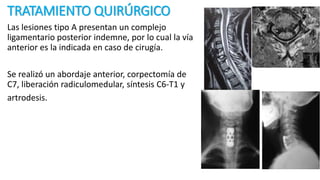 TRATAMIENTO QUIRÚRGICO
Las lesiones tipo A presentan un complejo
ligamentario posterior indemne, por lo cual la vía
anterior es la indicada en caso de cirugía.
Se realizó un abordaje anterior, corpectomía de
C7, liberación radiculomedular, síntesis C6-T1 y
artrodesis.
 
