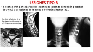 LESIONES TIPO B
• Se consideran por separado las lesiones de la banda de tensión posterior
(B1 y B2) y las lesiones de la banda de tensión anterior (B3).
Se observa la lesión de la
banda de tensión posterior
C5-C6 y compromiso discal
 
