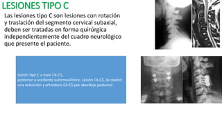 LESIONES TIPO C
Las lesiones tipo C son lesiones con rotación
y traslación del segmento cervical subaxial,
deben ser tratadas en forma quirúrgica
independientemente del cuadro neurológico
que presente el paciente.
Lesión tipo C a nivel C4-C5,
posterior a accidente automovilístico. Lesión C4-C5, Se realizó
una reducción y artrodesis C4-C5 por abordaje posterior.
 