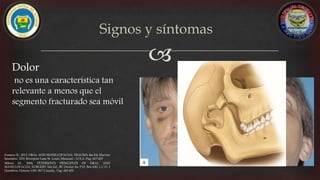 Dolor
no es una característica tan
relevante a menos que el
segmento fracturado sea móvil
Signos y síntomas
Fonseca R., 2013, ORAL AND MAXILLOFACIAL TRAUMA 4ta Ed, Elsevier
Saunders, 3251 Riverport Lane St. Louis, Missouri – U.S.A. Pag. 417-453
Miloro M., 2004, PETERSON'S PRINCIPLES OF ORAL AND
MAXILLOFACIAL SURGERY 2da Ed., BC Decker Inc P.O. Box 620, L.C.D. 1
Hamilton, Ontario L8N 3K7 Canada., Pag: 445-455
 