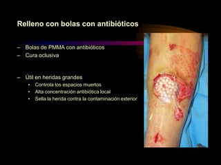Relleno con bolas con antibióticos
– Bolas de PMMA con antibióticos
– Cura oclusiva

– Útil en heridas grandes
•
•
•

Controla los espacios muertos
Alta concentración antibiótica local
Sella la herida contra la contaminación exterior

 