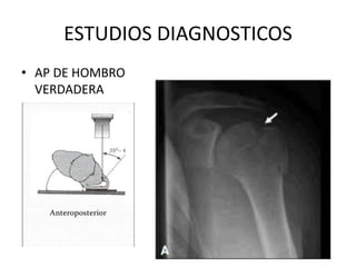 ESTUDIOS DIAGNOSTICOS
• AP DE HOMBRO
VERDADERA
 