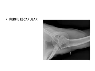 • PERFIL ESCAPULAR
 