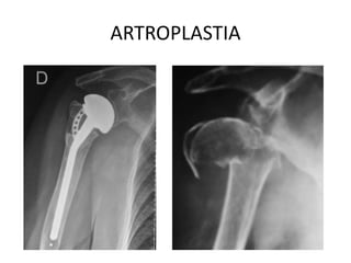 ARTROPLASTIA
 
