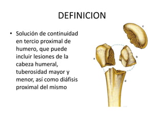 DEFINICION
• Solución de continuidad
en tercio proximal de
humero, que puede
incluir lesiones de la
cabeza humeral,
tuberosidad mayor y
menor, así como diáfisis
proximal del mismo
 