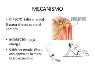 MECANISMO
• DIRECTO: (alta energia)
Trauma directo sobre el
hombro
• INDIRECTO: (baja
energia)
• Caida de propia altura
con apoyo en la mano y
brazo extendido
 