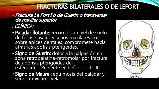 FRACTURAS LEFORT CLASIFICACION PDF