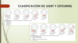 Judet Letournel Classification FRACTURAS DE ACETÁBULO.pptxtraumatologia | PPTX