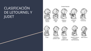 Judet Letournel Classification FRACTURAS DE ACETÁBULO EN PACIENTES POLITRAUMATIZADOS | PPTX