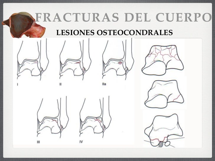 Fracturas del Astragalo