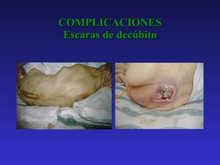 COMPLICACIONES Escaras de decúbito 