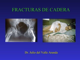 FRACTURAS DE CADERA Dr. Julio del Valle Aranda 