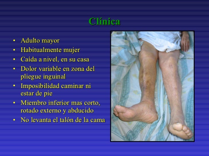 Fracturas de cadera