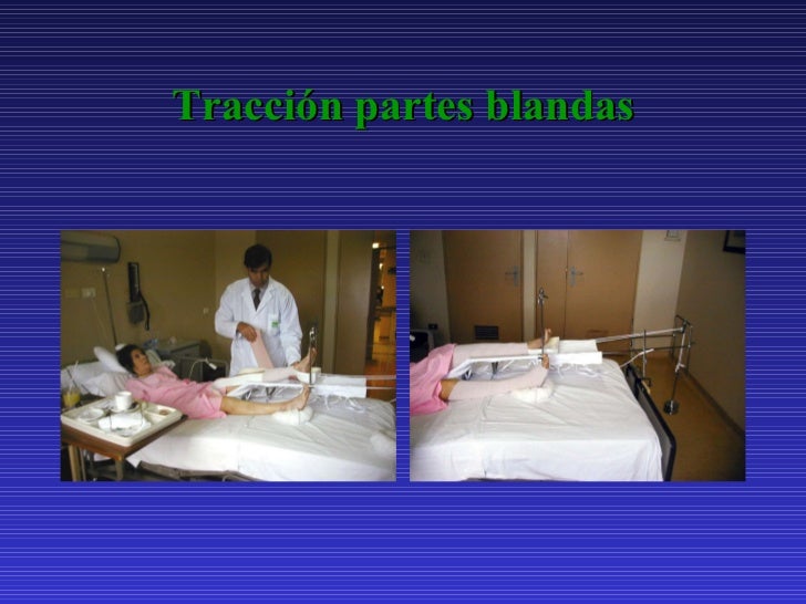 Fracturas de cadera Fracturas de cadera