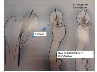CLAS. DE GARDEN DE Fx´S
DESPLAZADAS
NORMAL
RETROVERSION
ANTEVERSION
 