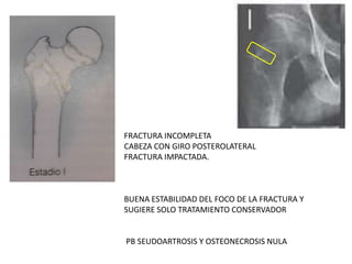FRACTURA INCOMPLETA
CABEZA CON GIRO POSTEROLATERAL
FRACTURA IMPACTADA.
BUENA ESTABILIDAD DEL FOCO DE LA FRACTURA Y
SUGIERE SOLO TRATAMIENTO CONSERVADOR
PB SEUDOARTROSIS Y OSTEONECROSIS NULA
 