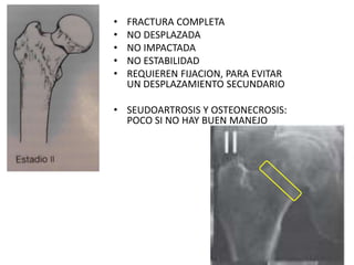 • FRACTURA COMPLETA
• NO DESPLAZADA
• NO IMPACTADA
• NO ESTABILIDAD
• REQUIEREN FIJACION, PARA EVITAR
UN DESPLAZAMIENTO SECUNDARIO
• SEUDOARTROSIS Y OSTEONECROSIS:
POCO SI NO HAY BUEN MANEJO
 