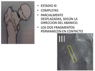 • ESTADIO III
• COMPLETAS
• PARCIALMENTE
DESPLAZADAS, SEGÚN LA
DIRECCION DEL ABANICO.
• LOS DOS FRAGMENTOS
PERMANECEN EN CONTACTO
 