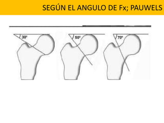 SEGÚN EL ANGULO DE Fx; PAUWELS
 