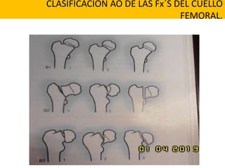 CLASIFICACION AO DE LAS Fx´S DEL CUELLO
FEMORAL.
 