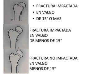 • FRACTURA IMPACTADA
• EN VALGO
• DE 15° O MAS
FRACTURA IMPACTADA
EN VALGO
DE MENOS DE 15°
FRACTURA NO IMPACTADA
EN VALGO
MENOS DE 15°
 
