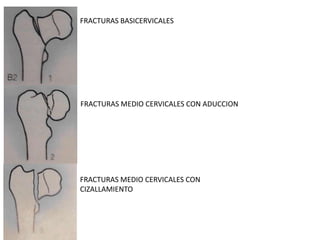 FRACTURAS BASICERVICALES
FRACTURAS MEDIO CERVICALES CON ADUCCION
FRACTURAS MEDIO CERVICALES CON
CIZALLAMIENTO
 