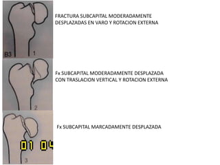 FRACTURA SUBCAPITAL MODERADAMENTE
DESPLAZADAS EN VARO Y ROTACION EXTERNA
Fx SUBCAPITAL MODERADAMENTE DESPLAZADA
CON TRASLACION VERTICAL Y ROTACION EXTERNA
Fx SUBCAPITAL MARCADAMENTE DESPLAZADA
 