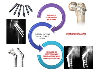 TORNILLOS
CANULADOS
MULTIPLES
FIJACION INTERNA
Fx´S DEL CUELLO
FEMUR
TORNILLO DE
COMPRESION DE
CADERA COLAPSABLE
CON PLACA LATERAL
HEMIARTROPLASTIA
 